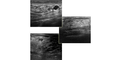 Ультразвуковые изображения молочной железы